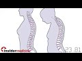 Insidermedicine in 60 - January 8, 2008  Osteoporosis Bones, Joints and Muscles