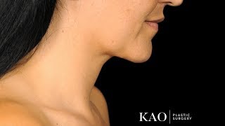 Micro Contouring of the Neck - Under Local Anesthesia