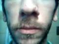 videos de paralisis nasal