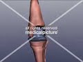 Knieprothese, prothesis of knee Knieprothese, prothesis of knee