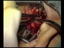 Canaloplasty-of-the-