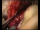 Canaloplasty-of-the-