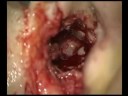 Canaloplasty-of-the-
