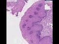 Histopathology Esophagus --Herpes esophagitis