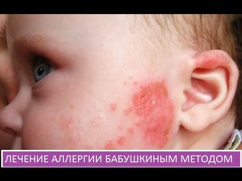 Псориаз лечение народными средствами пальцы рук