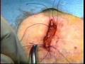 Temporal Artery Biopsy for Giant Cell Arteritis