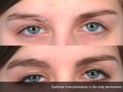 how to transplant eyebrows
