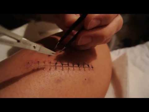 how to remove nylon stitches