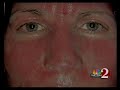 Reverse Sun Damage with the Fraxel Laser - Dr. Roger Bassin on Local 6 News Orlando