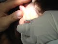 Zits behind the ear!