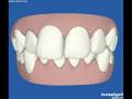 NS, San Jose Clincheck Invisalign