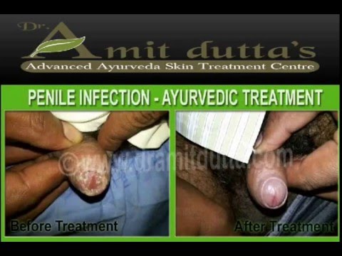 how to treat dle