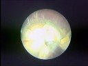 The treatment of bladder stone by using Vibrolith PLUS