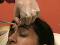 Learn about Botox injection- Upper face The Institute
