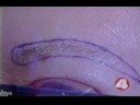 Hair Transplantation - \"Manly Men\"