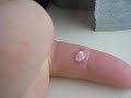 Formule W - Wart remover