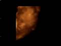 Renzo Njus 4D Ultrasound