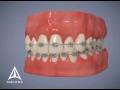 OrthoAccel - Acceledent Medical Device Animation