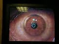 laser-eye-surgery-lasik.html