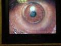 Laser - Eye Surgery - lasik