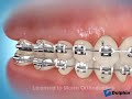 Complete Dental Retraction Using Mini-Screws