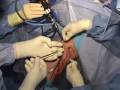 Medial Meniscus Replacement Surgical Technique