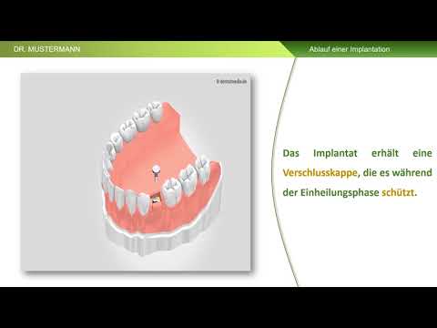 Ablauf einer Implantation