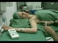 my newest treatment...for reflex sympathetic dystrophy.

this block is used for procedures of the hand, forearm, and elbow. an injection is given in the patient's axilla (armpit) into a space that surrounds a bundle of nerves that supply feeling to the lower arm. this is usually done with the patient awake with sedation, but can be done with the patient under general anesthesia. 

www.nerveblocks.net