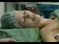 AXILLARY BRACHIAL PLEXUS BLOCK.