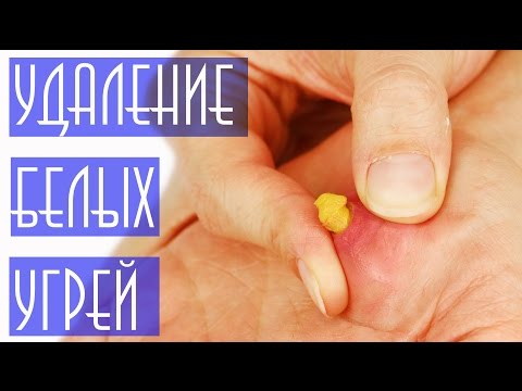 Большой стержень прыща Большой стержень прыща