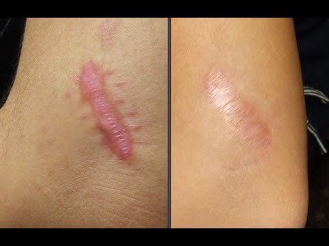 how to cure scars