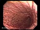 Endoscopia del Aparato Digestivo Superior de alta Resolución