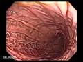Endoscopia del Aparato Digestivo Superior de alta Resolución