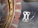 Anterior Cervical Fusion (Revision Surgery)