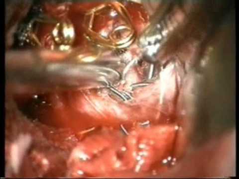 Previously Coiled Aneurysms Microsurgery - Experience on group of 81 patients - Video 1