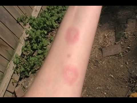 how to relieve erythema nodosum