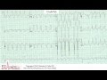 ECG Interpretation, Intermediate Level - Part 26 ECG Interpretation, Intermediate Level - Part 26