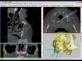 videos de Bioparts - Planejamento do Zigomático
