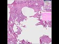 Histopathology Lung -- Aspiration pneumonia
