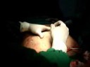 Tummy Tuck with C-Section Fakhr Alkhairy Consultant Tummy Tuck with C-Section Fakhr Alkhairy Consultant