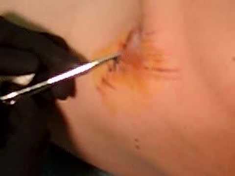 how to get a splinter out that is under the skin