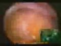 Myomektomi Ameliyatı Prof Dr Bülent Urman www.bulenturman.com