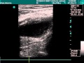 Popliteal Aneurysm In Doppler Exam Popliteal Aneurysm In Doppler Exam