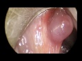 Vocal Cord Polyp Removal with Endoscope