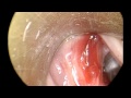 Endoscopic Removal of Vocal Cord Polyp Endoscopic Removal of Vocal Cord Polyp