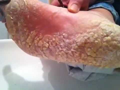 how to remove dead skin from feet