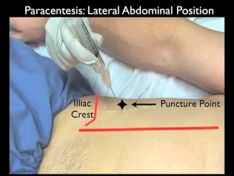 how to perform paracentesis