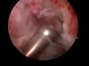 Arthroscopic ACL Reconstruction