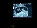 Our 4th Ultrasound, 9 weeks 4 days :D