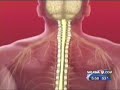 Healthy Eating for Spinal Cord Injury Patients